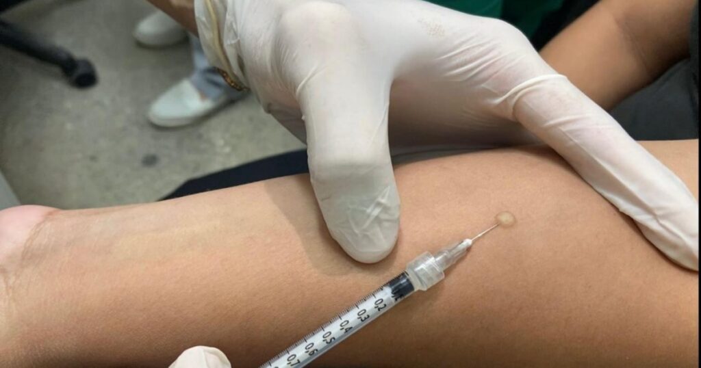 Rede de Manaus amplia rastreamento de infecção latente por tuberculose
